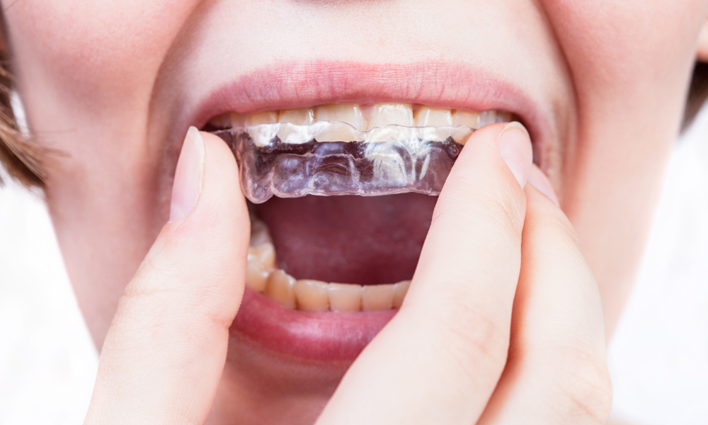 How To Make A Tooth Splint Mobile Teeth Solution With Splinting