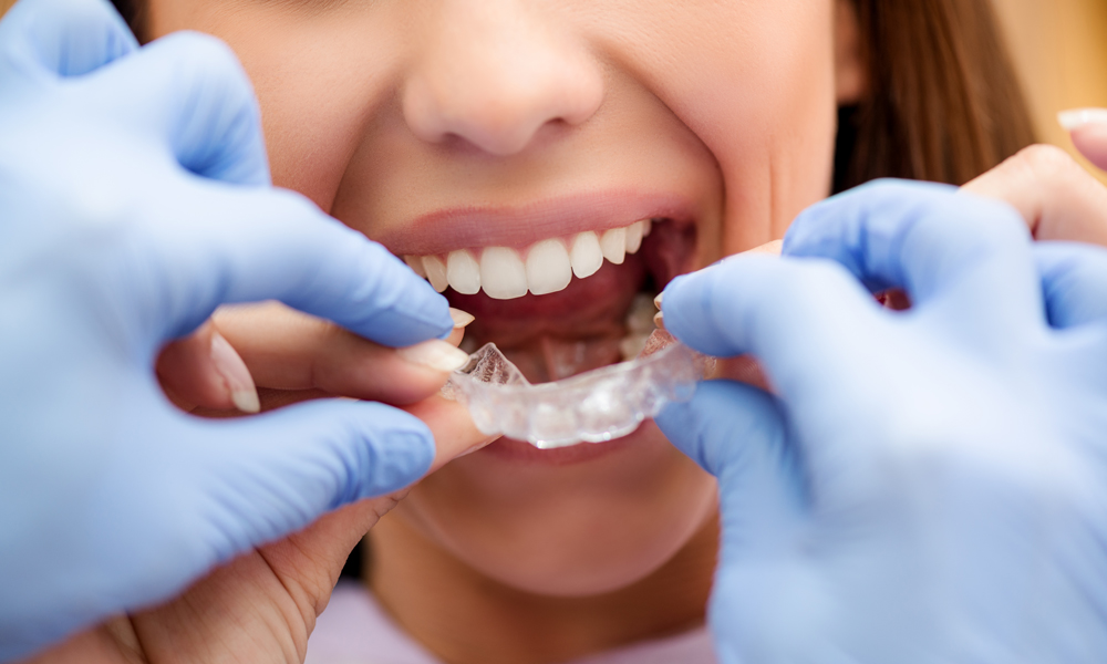 Clear aligner