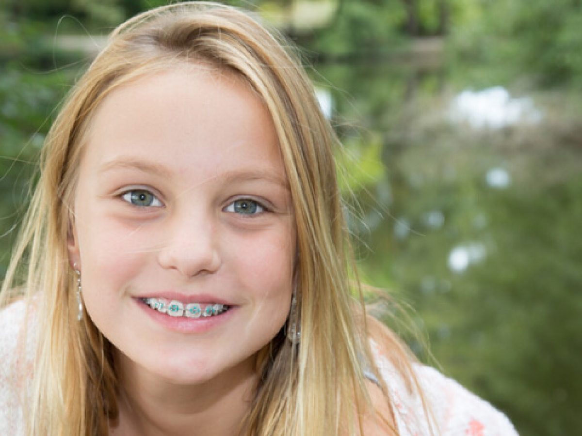 Braces For Us Braces Cost With Insurance Reddit