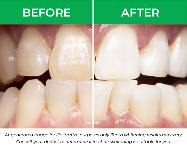 TeethWhitening_BeforeAfter_600x480px | No Gaps Dental Side-by-side comparison of teeth before and after dental whitening treatment.