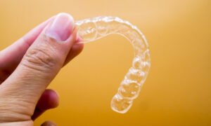 Clear Aligners Single Arch