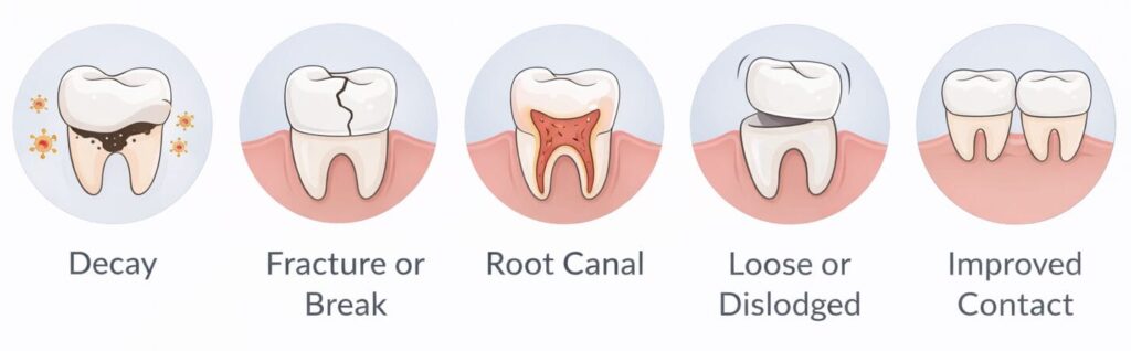 Signs that your crown needs replacing