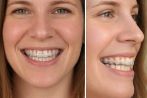 splint on a woman's teeth - front and side shots