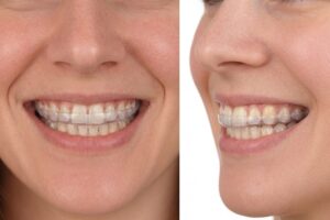 splint front side woman | No Gaps Dental Close-up view of a smile wearing splint.