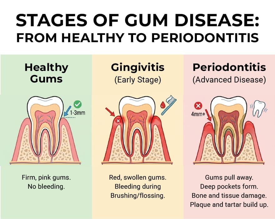 Stages of Gum disease