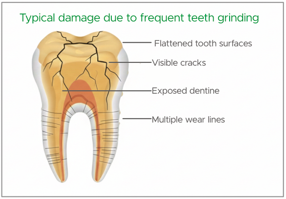 damage by teeth grinding text | No Gaps Dental Illustration of a tooth showing grinding damage: flattened surfaces, visible cracks, exposed dentin, and multiple wear lines.