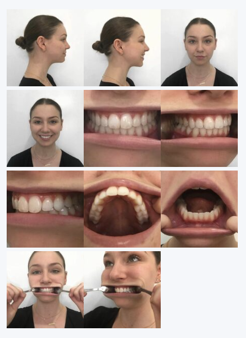 how to take photos for online aligner assessment